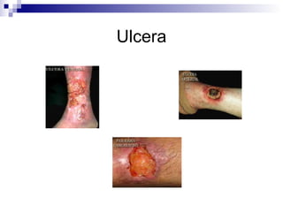 Ulcera 
