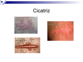Cicatriz 