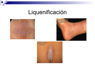 Liquenificación 