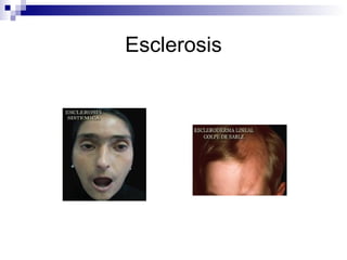 Esclerosis 