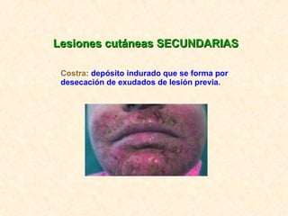 Lesiones cutáneas SECUNDARIAS Costra:  depósito indurado que se forma por desecación de exudados de lesión previa. 