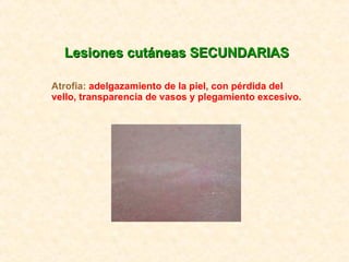 Lesiones cutáneas SECUNDARIAS Atrofia:  adelgazamiento de la piel, con pérdida del vello, transparencia de vasos y plegami...