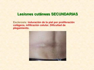 Lesiones cutáneas SECUNDARIAS Esclerosis:  induración de la piel por proliferación colágena, infiltración celular. Dificul...