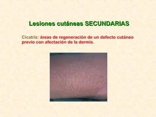 Lesiones cutáneas SECUNDARIAS Cicatriz:  áreas de regeneración de un defecto cutáneo previo con afectación de la dermis. 