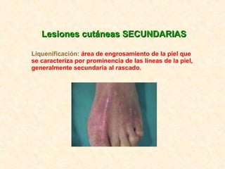 Lesiones cutáneas SECUNDARIAS Liquenificación:  área de engrosamiento de la piel que se caracteriza por prominencia de las líneas de la piel, generalmente secundaria al rascado. 