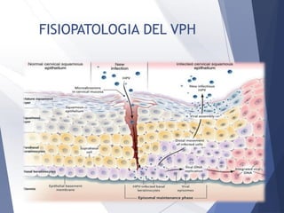 FISIOPATOLOGIA DEL VPH
 