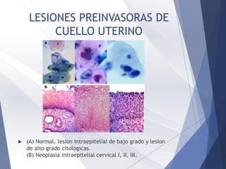 LESIONES PREINVASORAS DE
CUELLO UTERINO
 (A) Normal, lesion intraepitelial de bajo grado y lesion
de alto grado citologicas.
(B) Neoplasia intraepitelial cervical I, II, III.
 