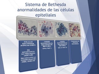Sistema de Bethesda
anormalidades de las células
epiteliales
 