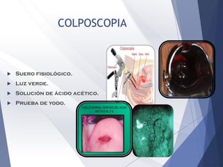 COLPOSCOPIA
 Suero fisiológico.
 Luz verde.
 Solución de ácido acético.
 Prueba de yodo.
 