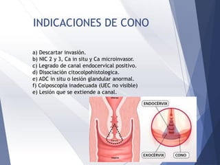 INDICACIONES DE CONO
a) Descartar invasión.
b) NIC 2 y 3, Ca in situ y Ca microinvasor.
c) Legrado de canal endocervical positivo.
d) Disociación citocolpohistologica.
e) ADC in situ o lesión glandular anormal.
f) Colposcopia inadecuada (UEC no visible)
e) Lesión que se extiende a canal.
 