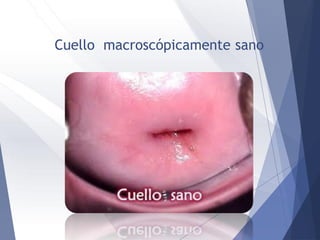 Cuello macroscópicamente sano
 