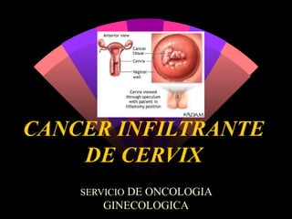 CANCER INFILTRANTE DE CERVIX SERVICIO  DE ONCOLOGIA GINECOLOGICA 