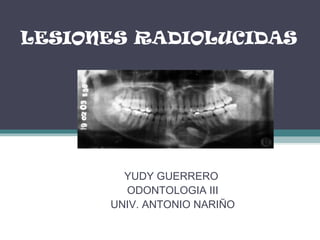 LESIONES RADIOLUCIDAS




        YUDY GUERRERO
        ODONTOLOGIA III
      UNIV. ANTONIO NARIÑO
 