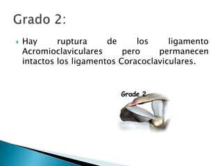 Hay ruptura de los ligamento Acromioclaviculares pero permanecen intactos los ligamentos Coracoclaviculares.Grado 2: