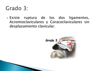 Existe ruptura de los dos ligamentos, Acromioclaviculares y Coracoclaviculares sin desplazamiento clavicular.Grado 3: