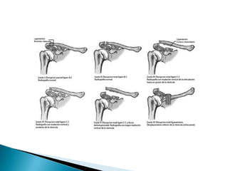 Lesiones acromioclaviculares
