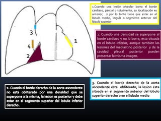 44
11
1.Cuando una lesión alveolar borra el borde
cardiaco, parcial o totalmente, su localización es
anterior, y por lo tanto tiene que estar en el
lóbulo medio, lingula o segmento anterior del
lóbulo superior
2. Cuando una densidad se superpone al
borde cardiaco y no lo borra, esta situada
en el lobulo inferior, aunque tambien las
lesiones del mediastino posterior y de la
cavidad pleural posterior pueden
presentar la misma imagen.22
33
3. Cuando el borde derecho de la aorta
ascendente esta obliterado, la lesion esta
situada en el segmento anterior del lobulo
superior derecho o en el lobulo medio
 