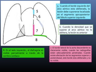 55
66
77
88
5. Cuando el borde izquierdo del
arco aórtico esta obliterado, la
lesión debe suponerse localizada
en el segmento apicoposterior
del lóbulo superior izquierdo
6. Cuando la densidad que se
supone al arco aórtico no lo
oblitera, la lesión es anterior
7. El borde lateral de la aorta descendente es
claramente visible, cuando las radiografías
están adecuadamente penetradas. Cuando
existe afectación de los segmentos superior y
posterobasal, este borde esta obliterado y no
es visible.
8. En el lado izquierdo , el diafragme es
visible parcialmente a través de la
sombra cardiaca
 