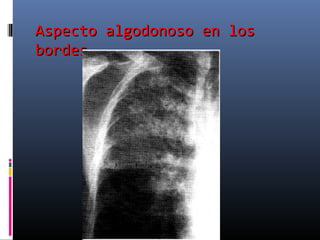 Aspecto algodonoso en losAspecto algodonoso en los
bordesbordes
 