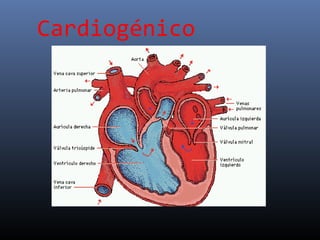 Cardiogénico
 