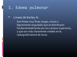 1. Edema pulmonar
 Lineas de Kerley A:
 Son líneas muy finas, largas, rectas o
ligeramente anguladas que se distribuyen
fundamentealmente por los campos superiores,
y que son más claramente visibles en la
radiografía lateral de torax.
 