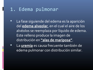 1. Edema pulmonar
 La fase siguiende del edema es la aparición
del edema alveolar, en el cual el aire de los
alvéolos se reemplaza por líquido de edema.
Este relleno produce la imagen de
distribución en “alas de mariposa”.
 La uremia es causa frecuente también de
edema pulmonar con distribución similar.
 