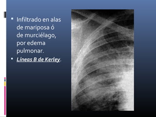  Infiltrado en alas
de mariposa ó
de murciélago,
por edema
pulmonar.
 Líneas B de Kerley.
 