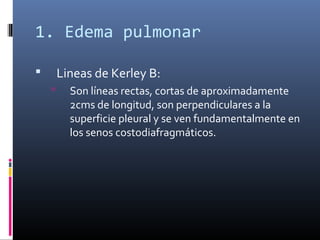 1. Edema pulmonar
 Lineas de Kerley B:
 Son líneas rectas, cortas de aproximadamente
2cms de longitud, son perpendiculares a la
superficie pleural y se ven fundamentalmente en
los senos costodiafragmáticos.
 