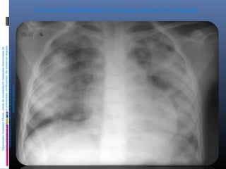 Síndrome de GoodPasture (Hemorragia pulmonar por nefropatía)
Opacidadesmoteadasdifusas,zonasdeconsolidaciónbilateralesdiseminadasde
modouniformeenamboscampospulmonares,confluyentes.Seconservanángulos
costodiafragmáticosindemnesaligualquelaszonasapicales.Adenomegalias
parahiliaresderechas.
 
