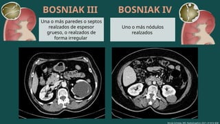 LESIONES BENIGNAS DEL RIÑON Estudio.pptx