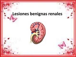 Lesiones benignas renales

 