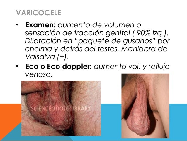 Tiene que aumentar cuanto la operación el miembro viril