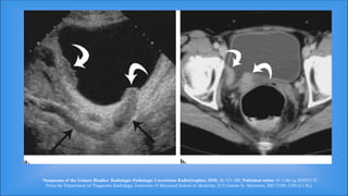 Comprehensive Overview of Benign and Malignant Renal and Bladder ...