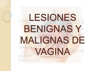 LESIONES BENIGNAS Y MALIGNAS DE VAGINA 