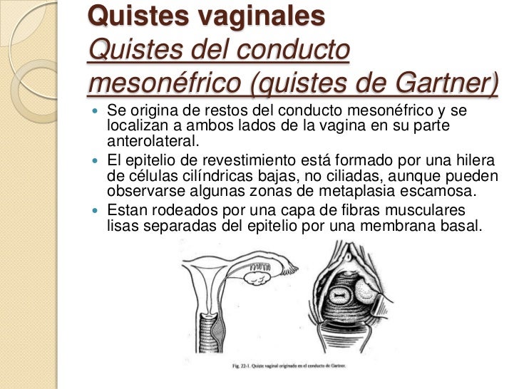 Lesiones Benignas Y Malignas De Vagina