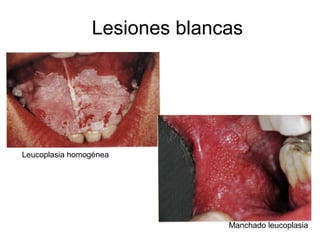 Lesiones blancas
Leucoplasia homogénea
Manchado leucoplasia
 