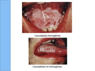 Leucoplasia homogénea
Leucoplasia no homogénea
 