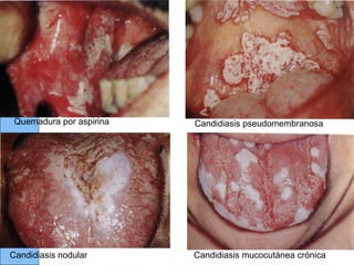 Quemadura por aspirina Candidiasis pseudomembranosa
Candidiasis nodular Candidiasis mucocutánea crónica
 