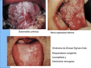 Nevo esponjoso blanco
Disqueratosis congénita
Leucoplasia y
Carcinoma veruugoso
Síndrome de Zinsser Egman-Cole
Estomatitis urémica
 