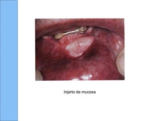 Injerto de mucosa
 