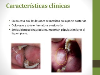 Lesiones Blancas De Cavidad Bucal PPTX lesiones-blancas-de-cavidad-bucal-pptx
