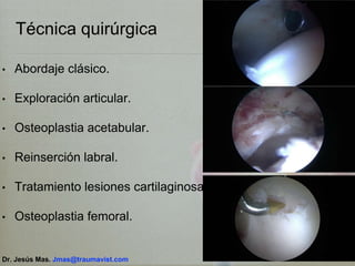 Técnica quirúrgica
• Abordaje clásico.
• Exploración articular.
• Osteoplastia acetabular.
• Reinserción labral.
• Tratamiento lesiones cartilaginosas.
• Osteoplastia femoral.
Dr. Jesús Mas. Jmas@traumavist.com
 