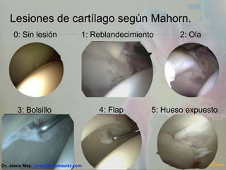 Lesiones de cartílago según Mahorn.
0: Sin lesión 1: Reblandecimiento 2: Ola
3: Bolsillo 4: Flap 5: Hueso expuesto
Dr. Jesús Mas. Jmas@traumavist.com
 