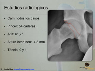 Estudios radiológicos
• Cam: todos los casos.
• Pincer: 54 caderas.
• Alfa: 61,7º.
• Altura interlínea: 4,8 mm.
• Tönnis: 0 y 1.
Dr. Jesús Mas. Jmas@traumavist.com
 