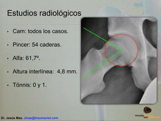 Estudios radiológicos
• Cam: todos los casos.
• Pincer: 54 caderas.
• Alfa: 61,7º.
• Altura interlínea: 4,8 mm.
• Tönnis: 0 y 1.
Dr. Jesús Mas. Jmas@traumavist.com
 