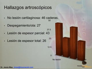 Hallazgos artroscópicos
• No lesión cartilaginosa: 46 caderas.
• Despegamiento/ola: 27
• Lesión de espesor parcial: 43
• Lesión de espesor total: 26
0
12.5
25
37.5
50
No lesión
46
27
43
26
Dr. Jesús Mas. Jmas@traumavist.com
 