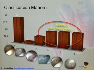 Clasificación Mahorn
0
12.5
25
37.5
50
0
1
2
3
4
5
46
4
15
25 26 26
Dr. Jesús Mas. Jmas@traumavist.com
 