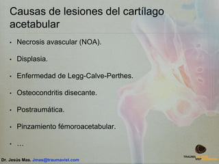 Causas de lesiones del cartílago
acetabular
• Necrosis avascular (NOA).
• Displasia.
• Enfermedad de Legg-Calve-Perthes.
• Osteocondritis disecante.
• Postraumática.
• Pinzamiento fémoroacetabular.
• …
Dr. Jesús Mas. Jmas@traumavist.com
 