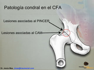 Patología condral en el CFA
Lesiones asociadas al PINCER
Lesiones asociadas al CAM
Dr. Jesús Mas. Jmas@traumavist.com
 