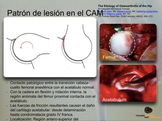 Patrón de lesión en el CAM
- Contacto patológico entre la transición cabeza-
cuello femoral anesférica con el acetábulo normal.
- Con la cadera en flexión y rotación interna, la
región anómala del fémur proximal contacta con el
acetábulo.
- Las fuerzas de fricción resultantes causan el daño
del cartílago acetabular: desde delaminación
hasta condromalacia grado IV franca.
- Localización: Región antero-superior del
The Etiology of Osteoarthritis of the Hip
An Integrated Mechanical Concept
Reinhold Ganz, MD, Michael Leunig, MD, Katharina Leunig-Ganz,
MD, and William H. Harris, MD, DS
Clin Orthop Relat Res. 2008 February; 466(2): 264–272.
 